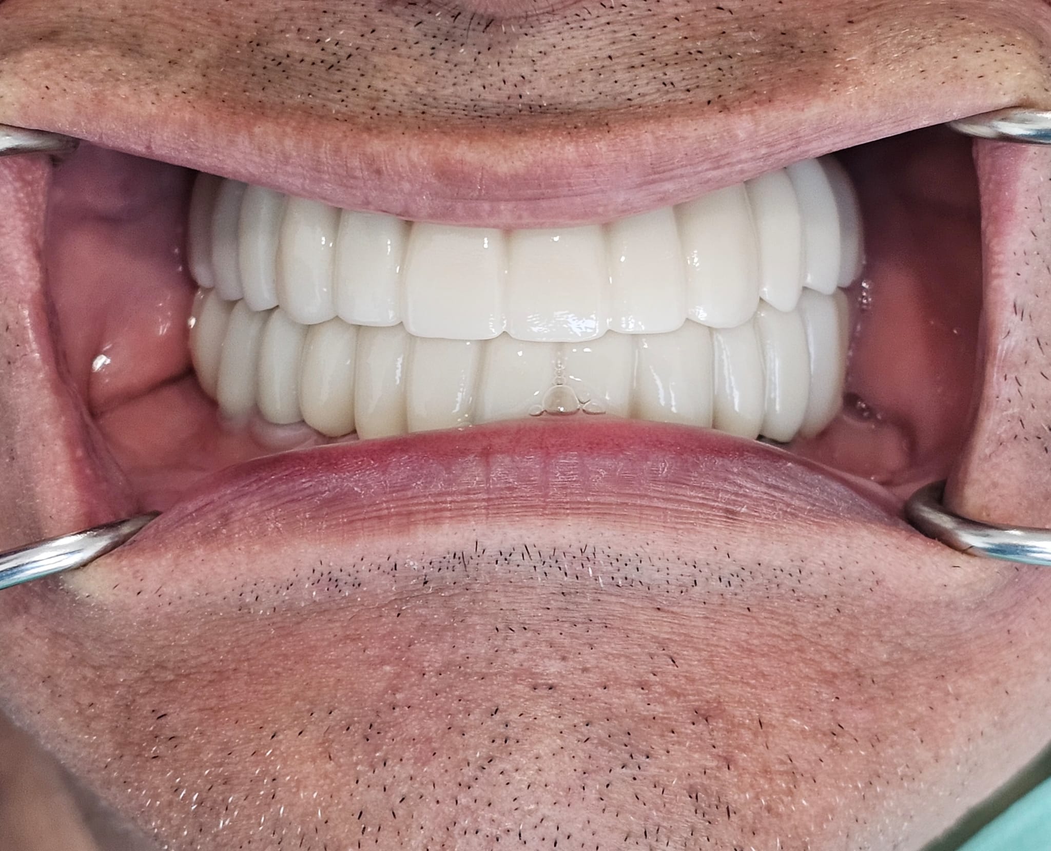 Full arch zirconia bridges result view two